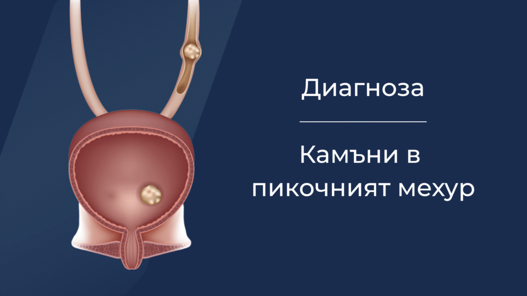 Диагностика на камъни в пикочния мехур – уролог в София