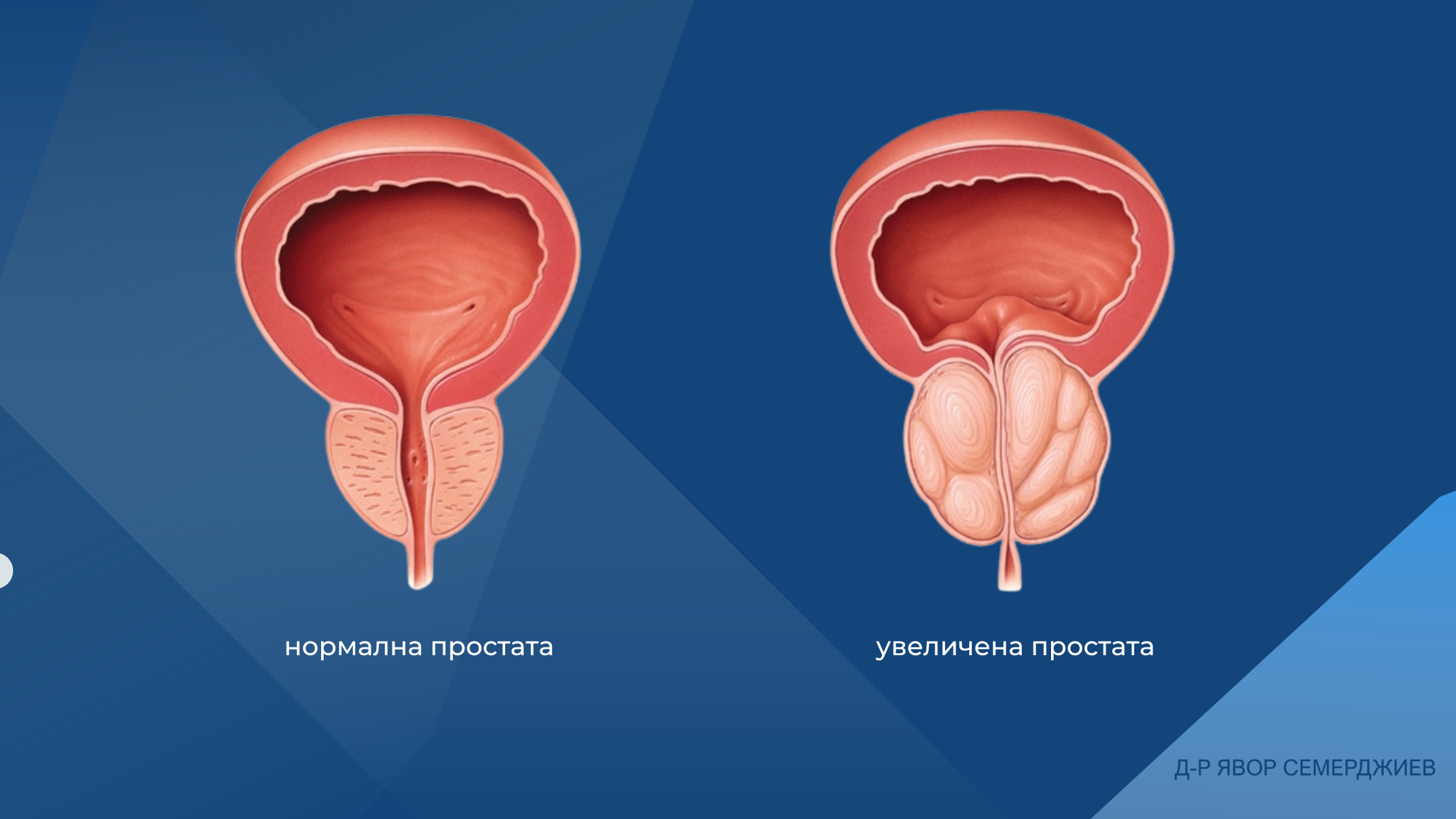 Read more about the article Честота на Доброкачественото Увеличение на Простатата (ДПХ)